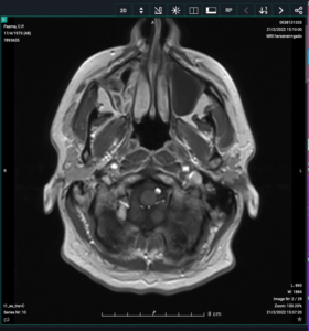 MRI Scan